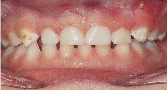 Picture of front teeth of kid after treatment for Early Childhood caries