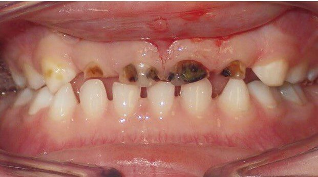 Picture of front teeth showing early childhood caries before treatment